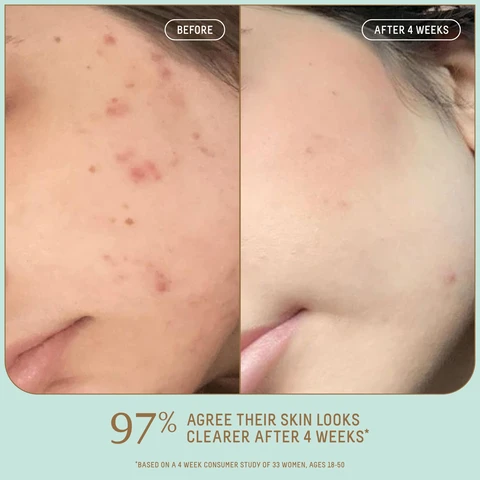 Image 1, before and after 4 weeks 97% agree their skin looks clearer after 4 weeks based on a 4 week consumer study of 33 women ages 18-50. image 2, before and after 14 days. image 3, after 1 use - 100% agree their skin looks calm and less irritated. 94% showed improvement in pore size. after 1 week - 94% agree redness was visibly improved. after 4 weeks - 97% agree their skin looks clearer. based on a 4 week consumer study of 33 women aged 18-50. based on a 4 week clinical study of 33 women aged 18-50. image 4, what is your skin microbiome? your skin's microbiome is a home to trillions of bacteria that fortify, protect and nourish skin. how do probiotics support your microbiome? when there are too many bad bacteria, probiotics restore balance by delivering a plethora of healthy bacteria to your microbiome. what are the benefits? a balanced microbiome results in less irritation, redness and excess oil for an overall healthy, clear complexion. image 5, find your moisture match. probiotic gel moisturiser - the redness reducer = skin type is oily to combination. texture = lightweight gel. results = calms and soothes while balancing the microbiome. vitamin c rose moisturiser - the instant brightener. skin type = normal to dry. texture = cushion cream. results = brightens complexion and fights free radicals. omega repair cream - the heavy duty hydrator. skin type = dry to mature. texture = rich cream. results = repairs the skin barrier and plumps fine lines and wrinkles. image 6, breakout-prone skin routine. step 1 = deeply cleanse with amino acid gentle cleanser. step 2 = BHA pore minimizing toner balances and clarifies. step 3 = 10% lactic acid resurfacing serum improves texture. step 4 = probiotic gel moisturiser calms and hydrated.