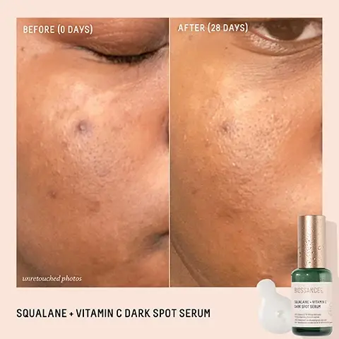 Image 1- Before and after images of a persons face showing skin improvement; the left side labeled Before (0 days) with visible blemishes, and the right side labeled After (28 days) with clearer skin, alongside a bottle of Squalane + Vitamin C Dark Spot Serum.
Image 2 - A green glass bottle of Biossance Squalane + Vitamin C Dark Spot Serum with a gold cap is displayed on a pink background, featuring text that states 100% agree the look of dark spots is improved, 100% agree the look of sun damage is improved, and 97% saw a visible improvement in fine lines and wrinkles, along with a note about a consumer study.
Image 3 - A turquoise tube of Biossance sunscreen with a golden cap sits on a light blue surface, surrounded by water droplets; the image includes text listing its benefits: invisibly blocks rays, weightlessly hydrates, prevents inflammation, blocks daytime aggressors, prevents blue light damage, and saves skin from pollutants.