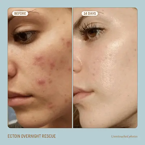 Image 1, BEFORE 14 DAYS ECTOIN OVERNIGHT RESCUE Unretouched photos Image 2, BEFORE AFTER 28 DAYS Unretouched photos SQUALANE + MARINE ALGAE EYE CREAM SQUALANE. MARINE ALGAE EYE CREA Image 3, BIOSSANCE. SQUALANE ECTOIN OVERNIGHT RESCUE MAGNESIUM + PEPTIDES: Reduce inflammation and minimize signs of sleep deprivation ECTOIN: A powerful stress- protection and moisture- binding molecule SQUALANE: Supports and replenishes skin's moisture barrier